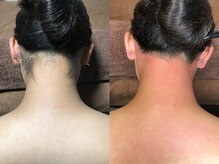 クラウン ジュエルズ(CROWN JEWELS)/うなじ脱毛　正面