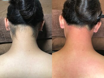 クラウン ジュエルズ(CROWN JEWELS)/うなじ脱毛 正面