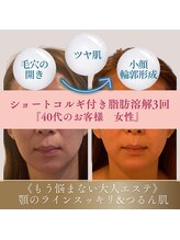 アンシャンテ(Anchant)/【半永久的に脂肪分解】