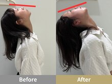 せなかのはね 難波心斎橋店/20代 女性 ストレートネック