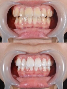 スマイル(SMILE)/セルフホワイトニング