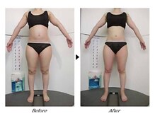 ビューティークリニックコダマ 延岡店/【1ヶ月コース】Y.H様（27歳）