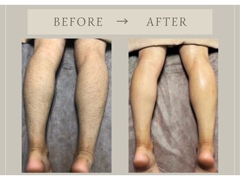 フェリチタトウキョウ(Felicita Tokyo)/【脱毛】全身脱毛