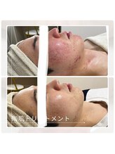 アチェリー(aCherry)/陶肌トリートメント