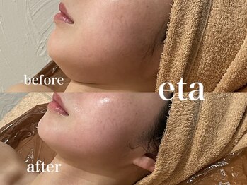 ストリ(STRI)/美容鍼＋高出力RF