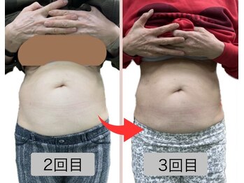 リセル(Recell)/お腹★脂肪分解