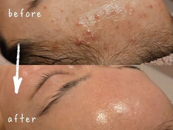 ボウ 静岡本店(VOEUX)/30代 額ニキビ 5回