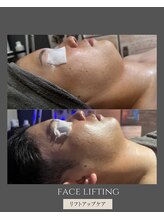 アルメ(arme)/【たるみ・二重顎ケア】