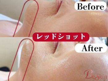 ビースキン 広島(BE:SKIN)/レッドショット/顎たるみ/引締め