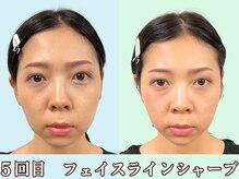 ナチュラルパーフェクトフェイス 新宿/整うとお化粧も楽に/新宿駅小顔