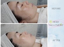 ティアス(t-us)/【弛み】ハーブトリートメント