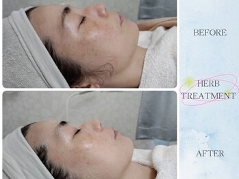 ティアス(t-us)/【弛み】ハーブトリートメント