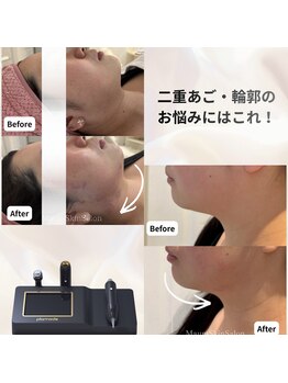 マウム(Maum)の写真/高周波×吸引リフティングですっきり小顔へ！二重あご・Vラインのお悩みに◎韓国で人気のメニューを体験♪