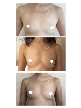 美人バスト 豊橋店/バストアップ症例【バストケア】