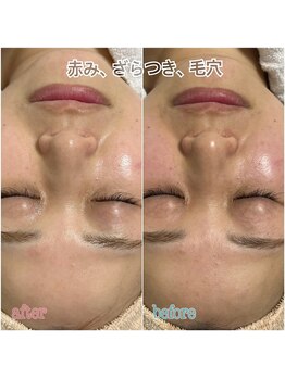 ルア 中野店(LUA)/肌質改善