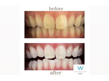 ホワイトニングショップ 島根店/Before&After美白ホワイトニング