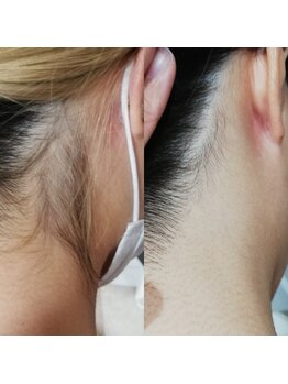 RiとBiのたまご/（脱毛）襟足１２回before-after