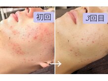 ボディーワークスナビ(Body Works Navi)/【ハーブピーリング】剥離なし