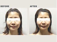 青空 チクシノサロン(SORA CHIKUSHINO SALON)/小顔実感◎韓国式コルギ#3