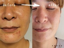 ボウ 静岡本店(VOEUX)/40代　顎ニキビ　3回