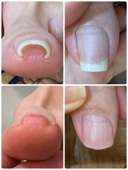 ミヨン 喜多見店(Miyong)/巻き爪