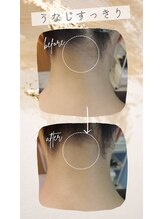 キアラ 麻布十番(Kiara)/麻布十番/毛穴/脱毛/顔脱毛