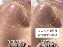 ラカ 明石(Laka)/鼻の黒ずみ・毛穴開き・イチゴ鼻