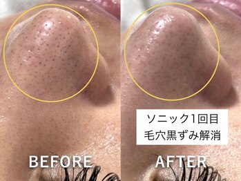 ラカ 明石(Laka)/鼻の黒ずみ・毛穴開き・イチゴ鼻