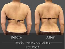 【次世代脂肪冷却・小顔ハイリフト専門店】ECLATOA　四日市/痩身/ダイエットの雰囲気（【脂肪冷却】脂肪冷却2カップ×EMSでしっかりサイズダウン！）