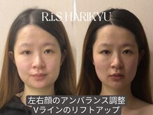 リス(R.i.S)/小顔矯正Before&After
