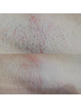 RiとBiのたまご/（脱毛）ワキ１２回before-after