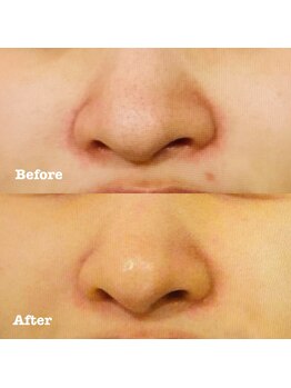 アユアランリンク 札幌店/20代前半/毛穴と赤み