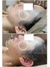【話題の大人気エステ版ポテンツァ】！韓国女優肌を目指せる！29800→16500
