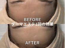 アリュメント(Allument)の雰囲気（ダーマエステ１回でおでこのシワが薄くなりました）