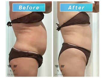 エムプラス(Mplus.)/痩身スリムカッター!!