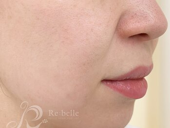 フランジスパ(FRANGI SPA)/リベルハーブピーリング6日目