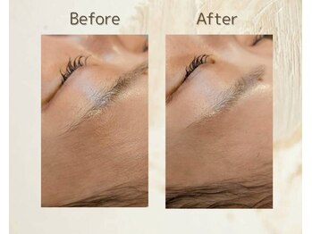 アンダブル(Andouble)/ビフォーアフター(お顔剃り)