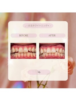 プラスビー 2号店(+b)/ホワイトニングビフォーアフター