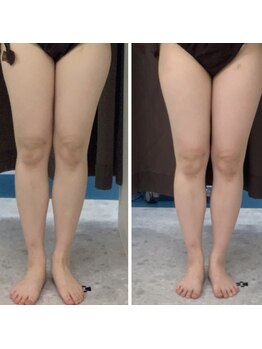 ソルニス(Solnis.)/痩身☆脂肪分解/ハイパーナイフ