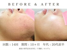 ロエヴェ(ROEWE)/ニキビ改善・毛穴ケア・肌質改善