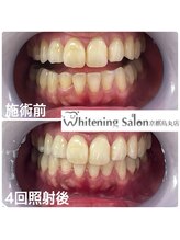 ホワイトニングサロン 京都烏丸店/ホワイトニング施術例