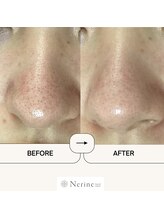 ネリネ(Nerine)/パワーアップした毛穴洗浄♪