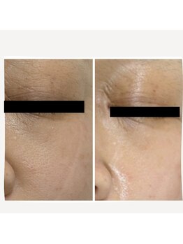 ミヤビ(miyabi)/小顔矯正