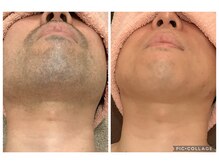 ラ ボーテ(La Beaute)/《メンズ》髭脱毛