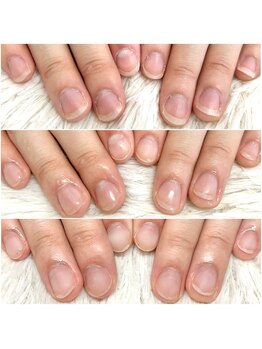 自爪育成/深爪矯正