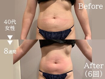 セレブリボーン 大阪ボーテ/サーモシェイプDEEP