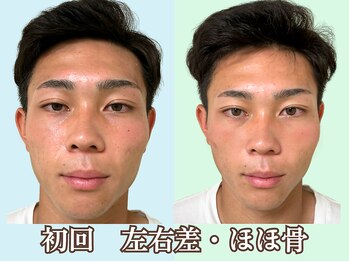 ナチュラルパーフェクトフェイス 新宿/２０才・初回メンズ新宿小顔矯正