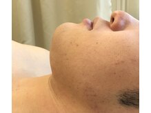 ビビ(BIBI)/ヒゲ脱毛4回目のお客様