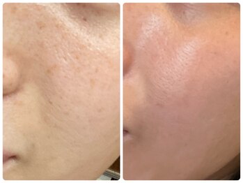 ジェミニ フェイス デザイン(Gemini Face Design)/REVI陶肌トリートメント