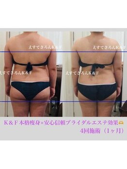えすてさろん ケイアンドエフ(k&f)/施術結果1ヶ月/4回